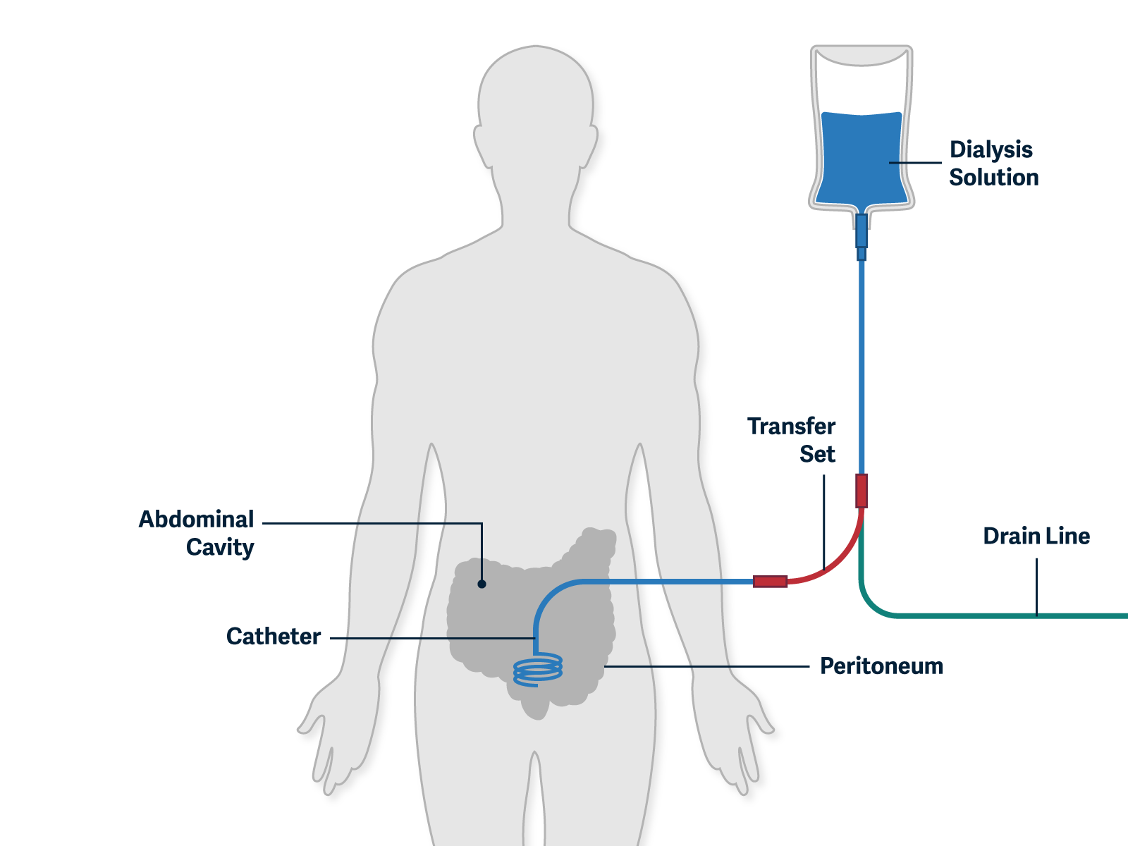 Kidney Care Options Peritoneal Dialysis | U.S. Renal Care