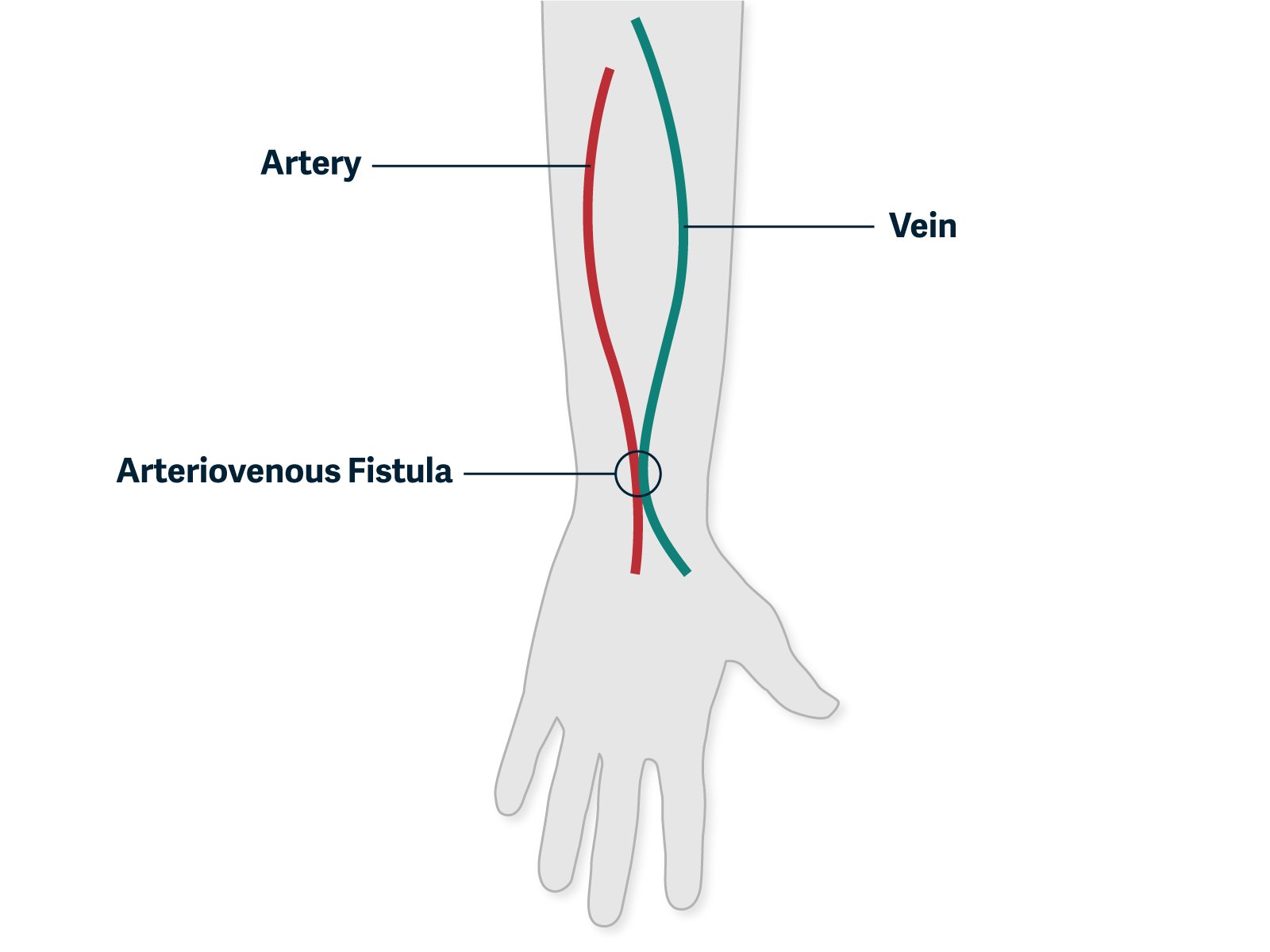 graphic showing a fistula