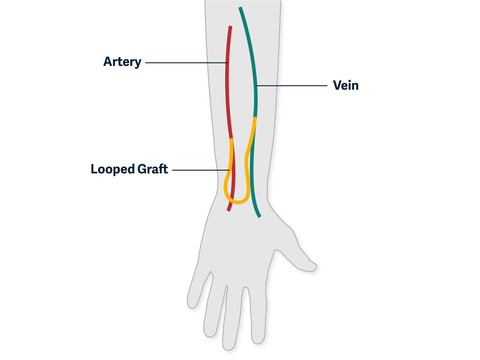 graphic showing a graft